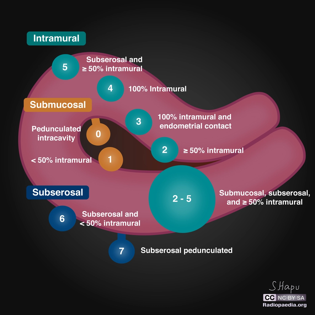 Fibroid diagram